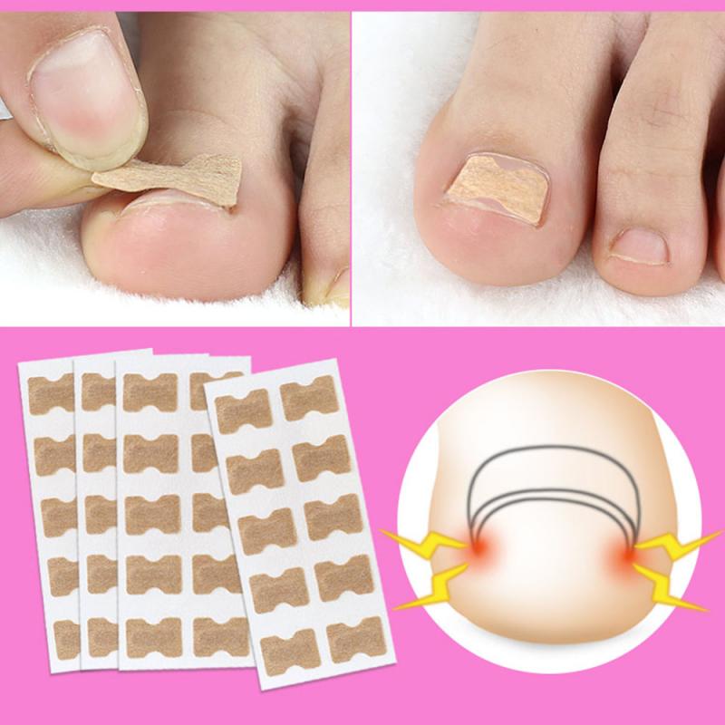 5pcs-nail-strips-anti-roll-free-glue-toe-inlay-nail-corrector.jpg