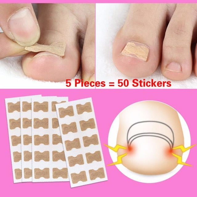 5Pcs Nail Strips Anti-roll Free Glue Toe Inlay Nail Corrector - COOLCrown Store